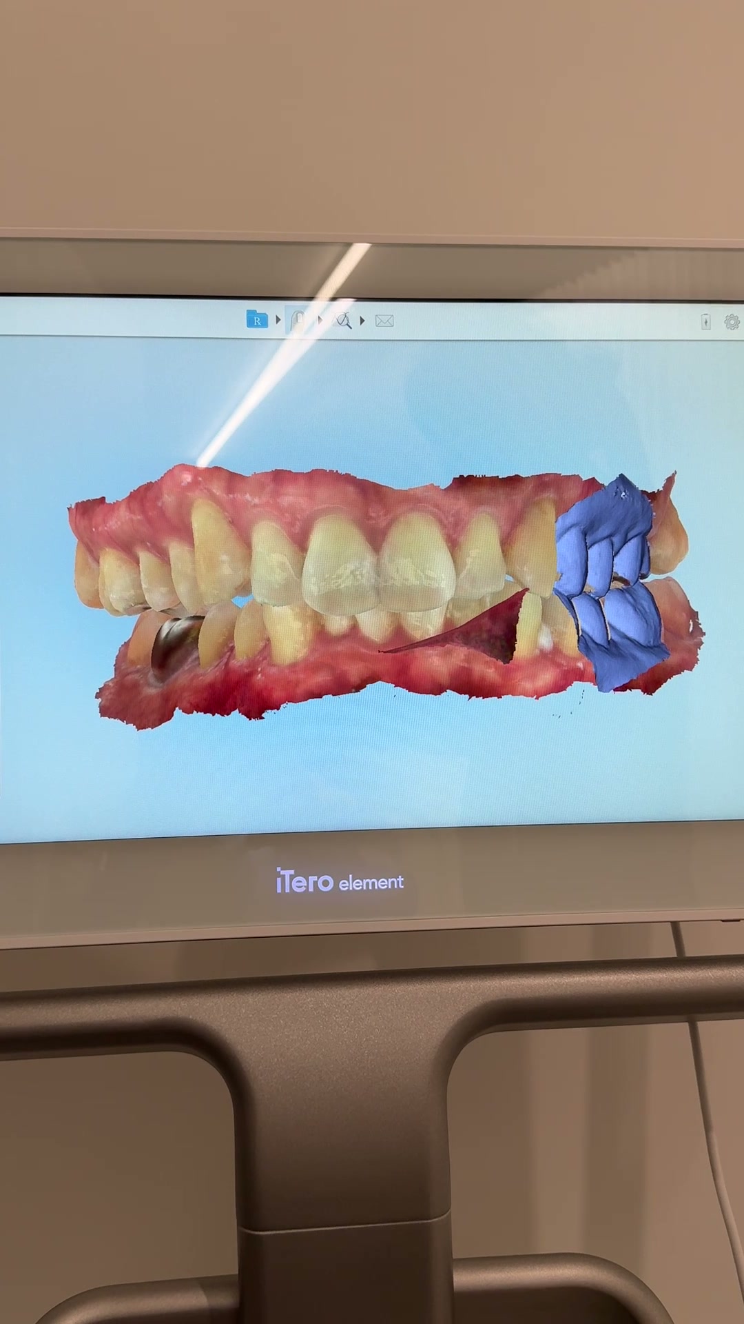 無料診断で表示された歯並びの3Dスキャン画面